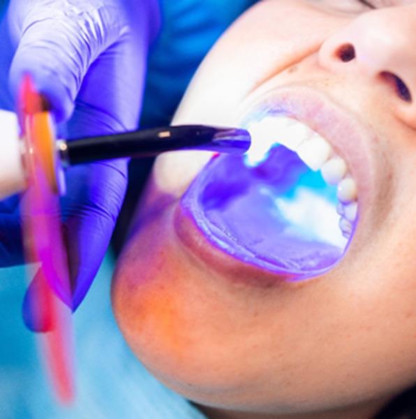 A dentist using a curing light to set tooth-colored resin 