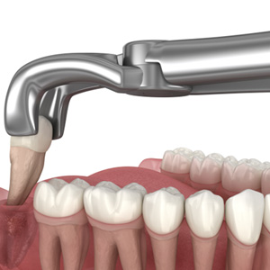 One factor that may affect the cost of your wisdom tooth extraction is the number of teeth that need to be removed