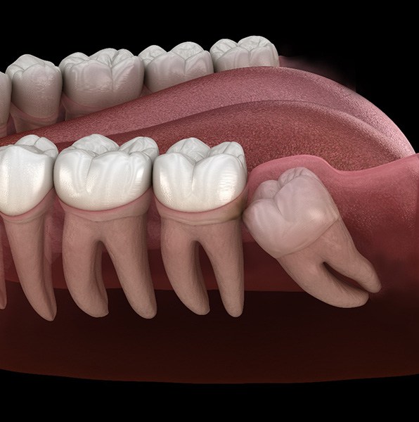 Illustration of wisdom tooth growing in