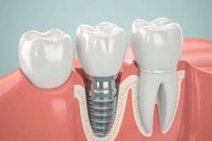 CGI rendering of a dental implant between 2 other teeth