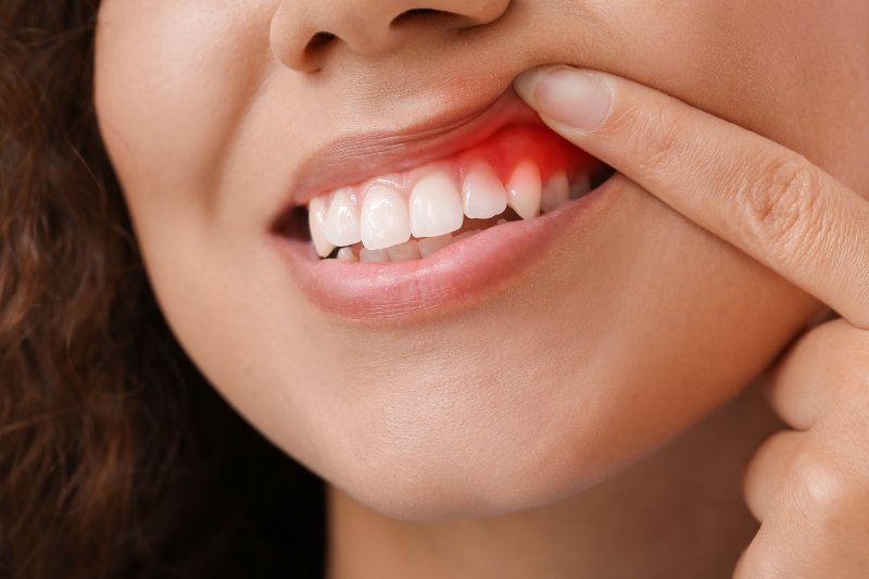 A closeup of a mouth with gum disease